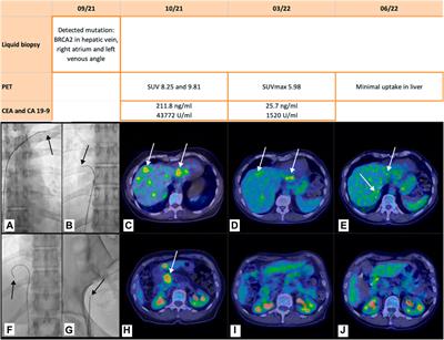 Case Report: Potential role of selective venous sampling for liquid biopsy in complex clinical settings: Three case presentations